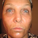 One hour after procedure