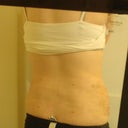 After/ 5 days post-op