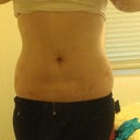 After/ 5 days post-op