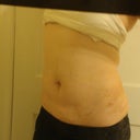 After/ 5 Days Post-op