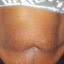 Before my surgery