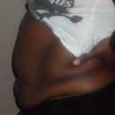 Before my surgery