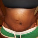 1 month after surgery......still swollen