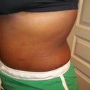 1 month after surgery