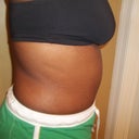1 month after surgery