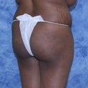 Before surgery