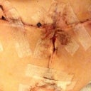 Under the right breast. A little concerned about the wound not be closed right enough.