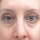 Week 4 (31 days after injections: 27 days of droop)