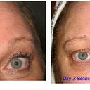 Botox review - botox not worth it