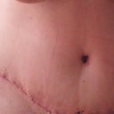 Close up on incision.  Still hunched over so my torso looks pretty short.