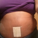 4 weeks post op