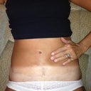 Scar at 6 months post op