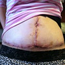PO DAY 7 - My belly button looks so weird and not like a belly button. :(