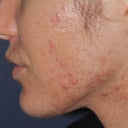 Before & After Photodynamic Therapy
