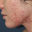 Before & After Photodynamic Therapy