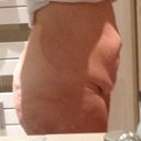 Before. Side view.  Yuck! :-(. I was soooo sad and miserable.