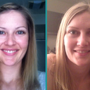 Comparison of my old nose to new nose - two weeks post-op.