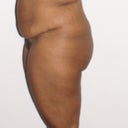 Dr. J said I need a TT but when I told him how much I weighed and how much I wanted to lose he said, "Wow you don't look that big so let's wait to add the TT until after you lose weight  bc you may not need it."