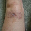 left knee showing scarring 3 months after