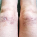 3 months after procedure 