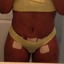 4 day post op LIPO of flanks, abs and thighs