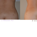 My backside, where I had my flanks and lower back lipo, middle right above crack was a large amount of fat removed.