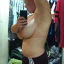 Bruising from the bra.