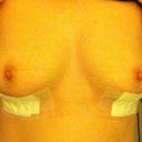 6 days post op. Right side slightly swollen.