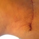 R side. Pleating almost gone. Scar is straight.