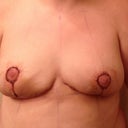 day 3 post op