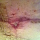 Incision at T Join not healing. It's very weepy and I have to put a plaster over It or it drips. Any suggestions on how to help it dry up.