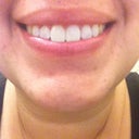 My teeth right after the session!