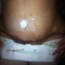 incision on Tuesday 7/10