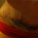 Incision 7/13 it is black because of the reaction to the healing sticks