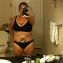 before second tt and thigh lift