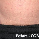Before right groin scar revision