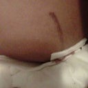 Few hours after surgery