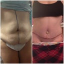 Left is an hour before surgery in hospital gown/underwear - Right side is 6 days post op.