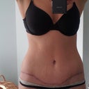 PO week 15 - The red line is some therapy I am attempting on a stretch mark.  Hope it works!!  Scar is flat, should start fading in the next few months.  Doing massage with oil for my scar therapy.