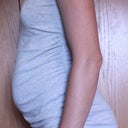 10 days before surgery