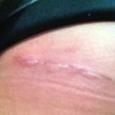 Incision day 8