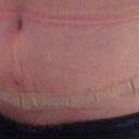 My scar.  The stretch mark right below my belly button is still puffy.  Freddy says when it begins to look like a normal stretch mark (flat), I will know that I don't have any more swelling.