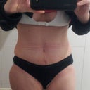 Underwear hiding my scar - I have a waist!  Can't wait until I can start working out!