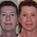 Before and after full facelift. Now, I can live with this.