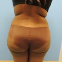 Before Lipo