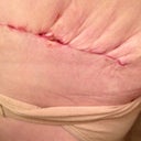 My "pleated" love handles! PO day 14. Dr says this should flatten out. ?