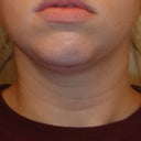 3 Weeks Post - Front