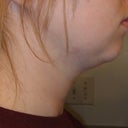 3 Weeks Post - Right Side