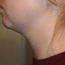 3 Weeks Post - Left Side