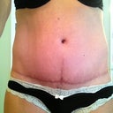 Front at 12 weeks PO